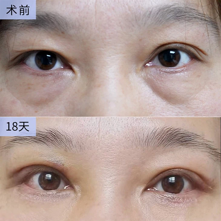 3Eye Corner Reshaping Treatment